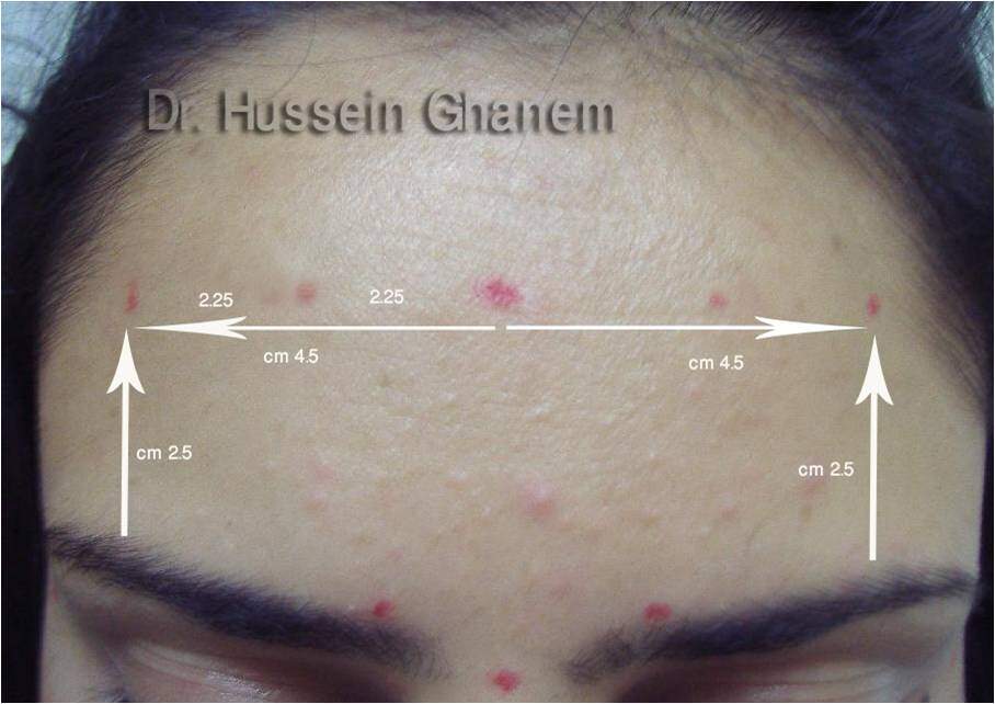 Geometric Wrinkle Injections – DermaHealth