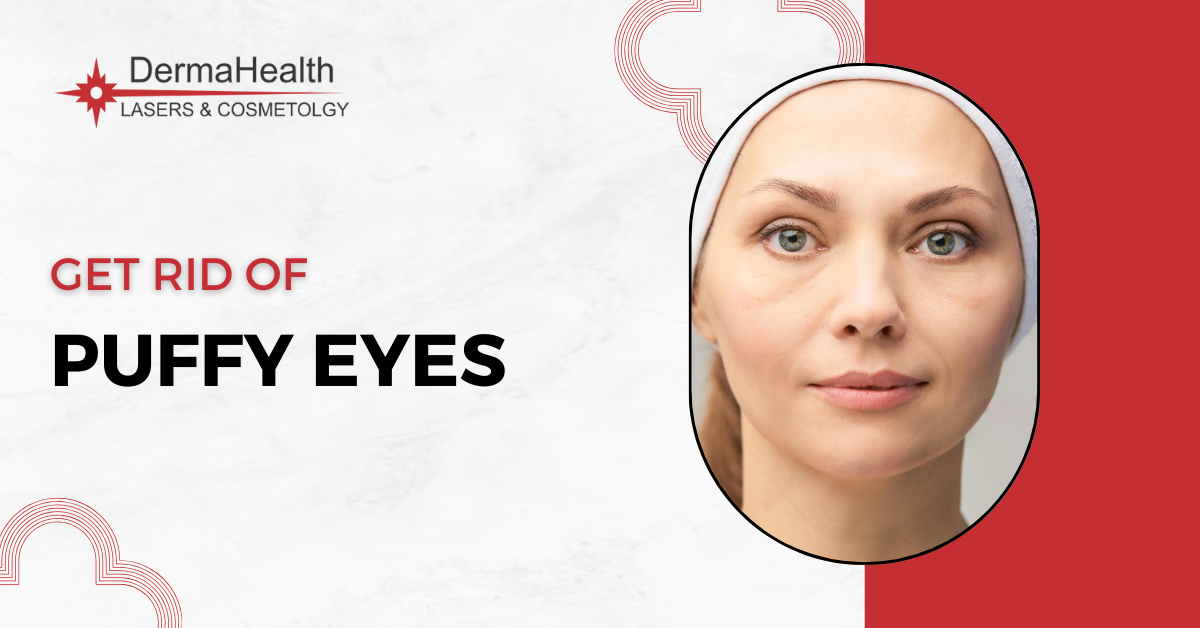 Puffy Eyes: Causes and How To Get Rid of Puffy Eyes